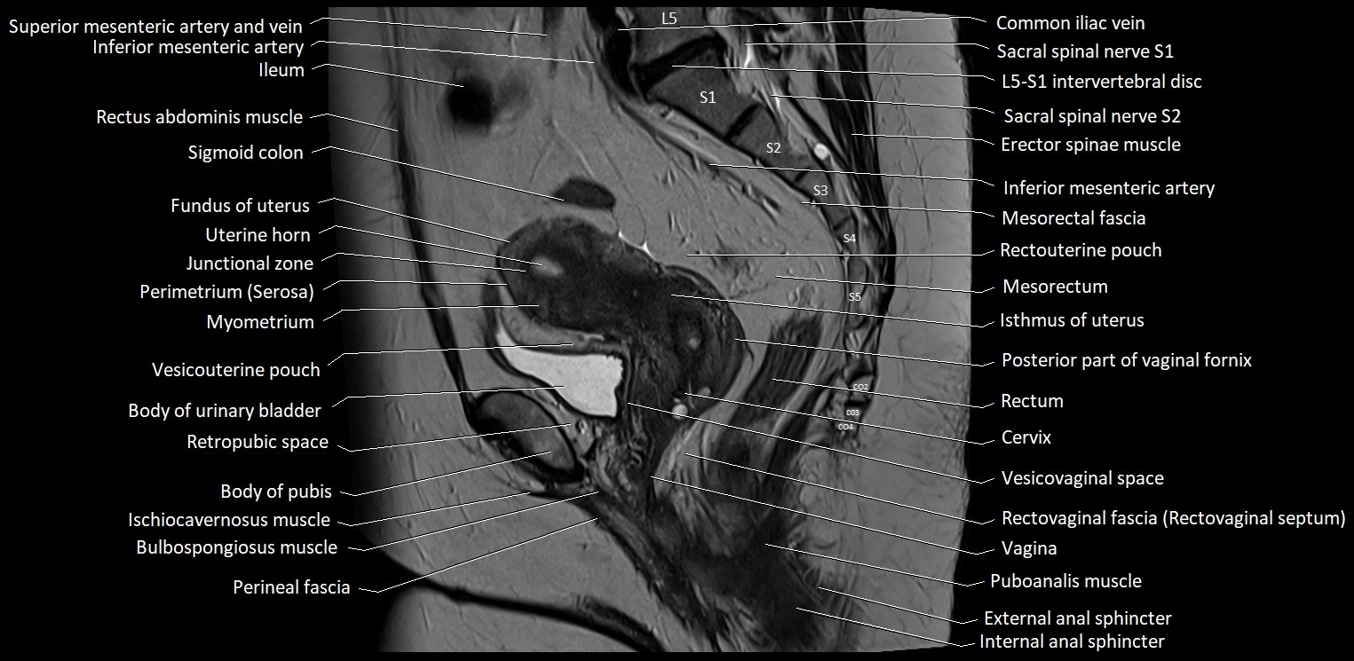 Sagittal cross sectional anatomy of female pelvis (MRI 3T) image 24.webp